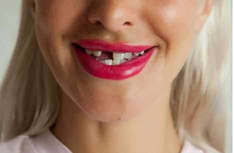 Женщина не смогла попасть к бесплатному стоматологу и вырвала себе 11 зубов